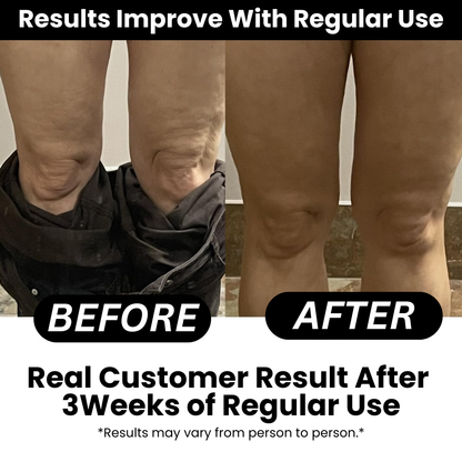 SmoothRise™ Anti-Cellulite Massage Roller